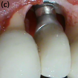 Periimplantitis-Defektkonfiguration nach vollständiger Entfernung des  Granulationsgewebes