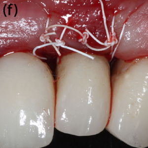 Der Gingiva-Lappen wird repositioniert, wodurch eine nicht-submergierte Heilung ermöglicht wird